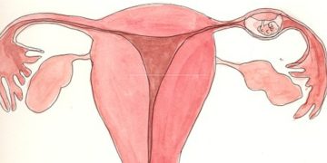 Ectopic Pregnancy